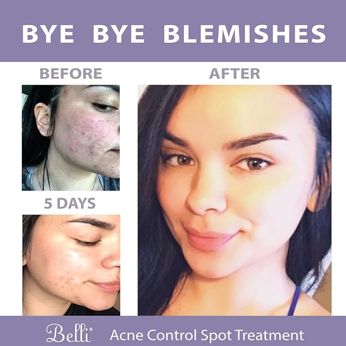 Belli Skincare Acne Control Spot Treatment - Image 6